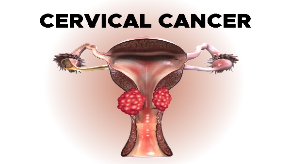 About cervical cancer