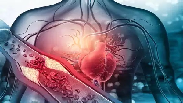 High cholesterol and heart attack: શા માટે વધી રહ્યો છે યુવાનોમાં હાર્ટ એટેકનો ખતરો? અને થાય છે હાઇ કોલેસ્ટોલની સમસ્યા