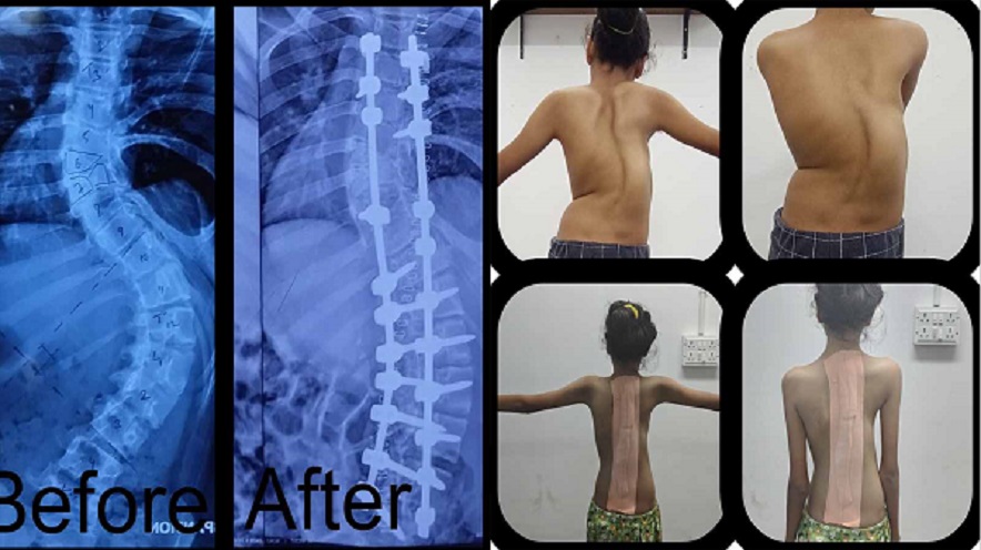 Spine Surgery in Civil Hospital: ઇન્ડો-અમેરિકન વર્કશોપ ફોર સ્પાઇન સર્જરી ઇન સરકારી સ્પાઇન હોસ્પિટલ !!! 1 spin